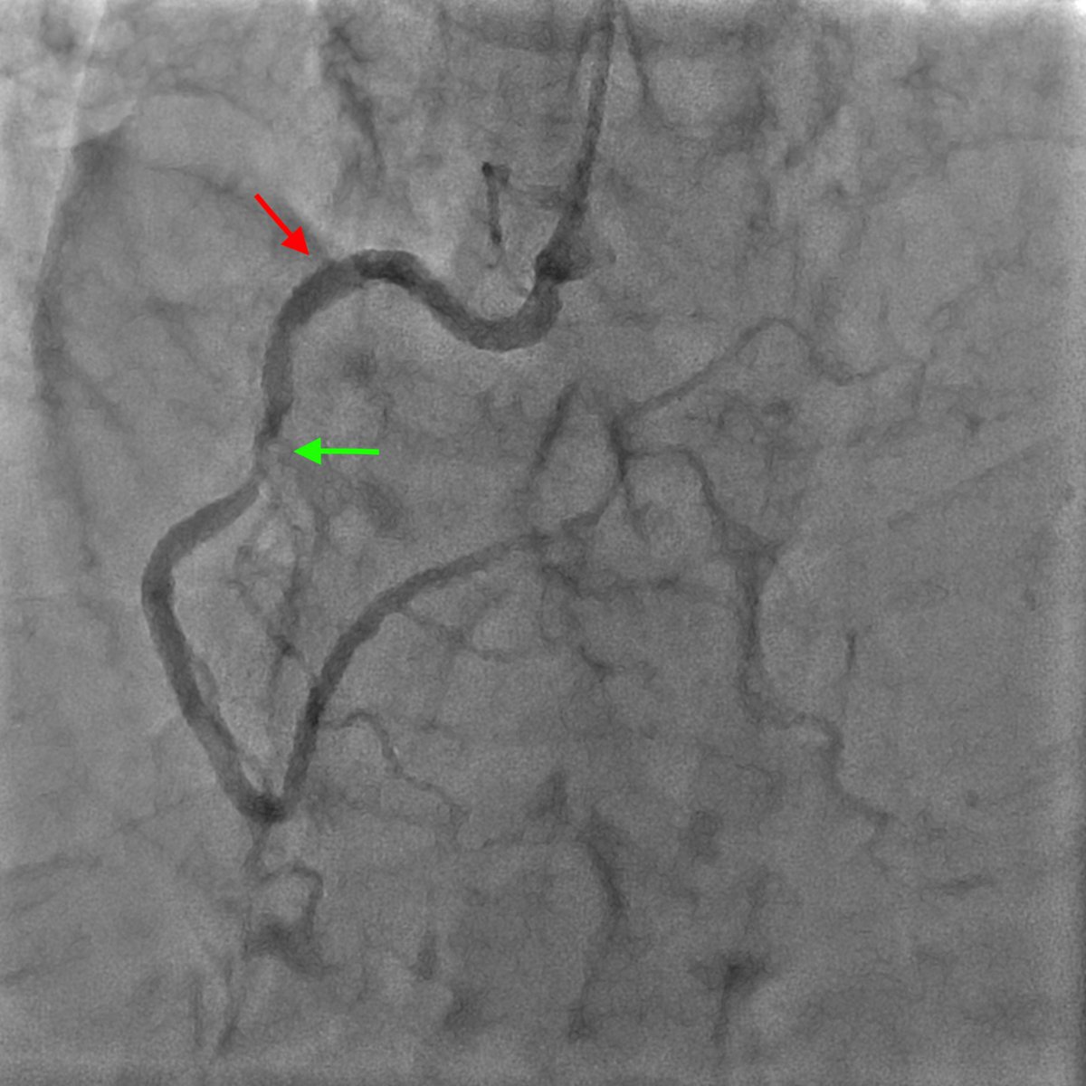nicolasamabile's tweet photo. 74 y-o man with stable angina-previous PCI 18 months before (red arrow) and de novo mid RCA lesion (green arrow) https://t.co/fwWIPCmHPg