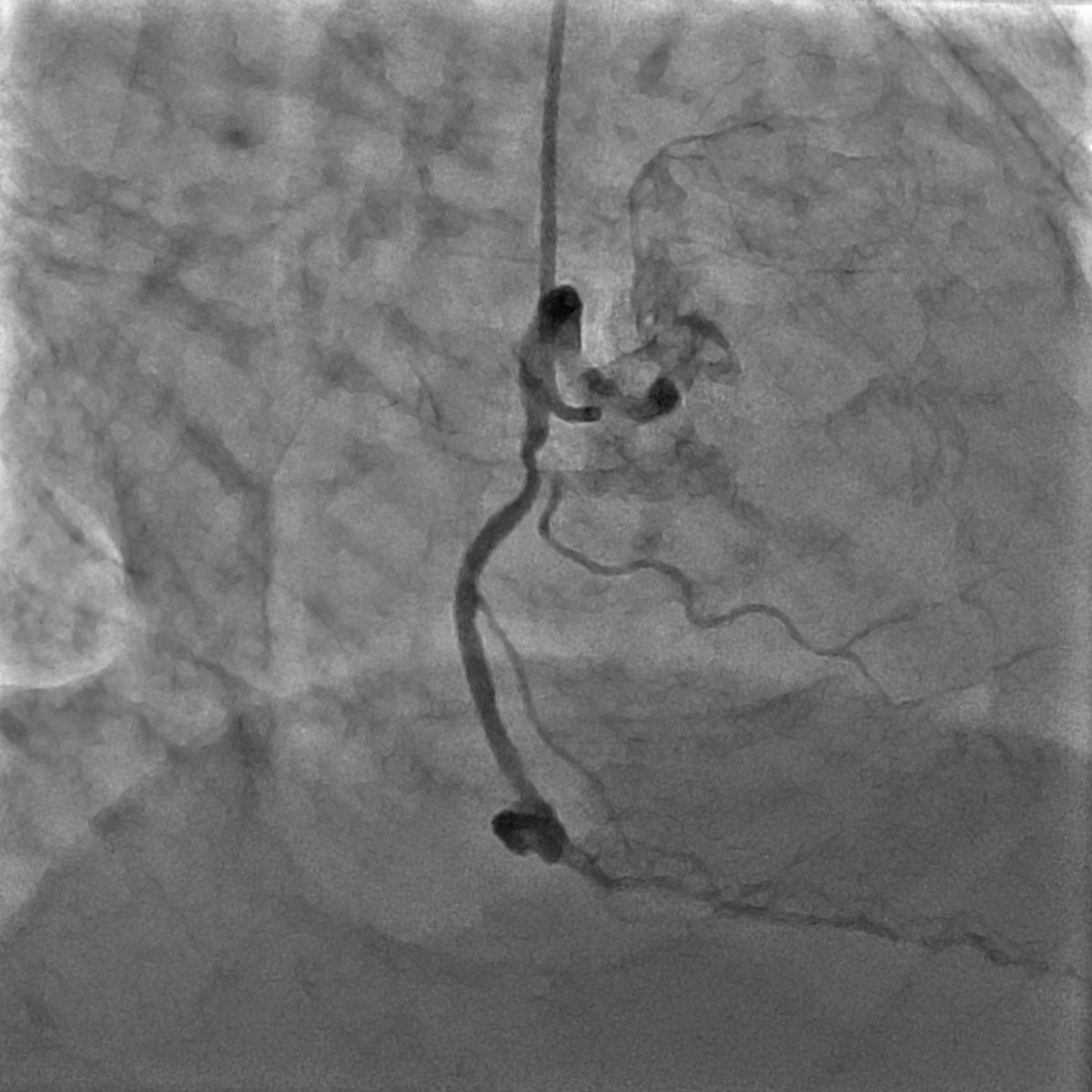 74 y-o man with stable angina-previous PCI 18 months before (red arrow) and de novo mid RCA lesion (green arrow)