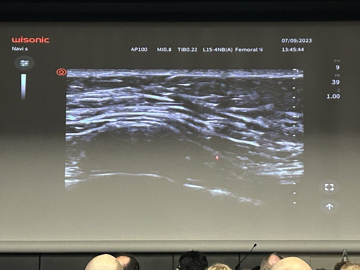 Jon Bailey MD MSc FRCPC EDRA 🇨🇦🧗🏄♂️ (@jon_bailey_anes) on Twitter photo Live scanning session with <a href="/anesthesiadocmd/">Melody Anderson (Herman), MD</a> <a href="/SreeHPraveenKO1/">Sree H Praveen Kolli</a>
#ESRAworld2023 <a href="/ESRA_Society/">ESRA | European Society of Regional Anaesthesia</a>
Demonstrating ~20 fascial plane blocks live. No pressure! Right?! Live scanning session with <a href="/anesthesiadocmd/">Melody Anderson (Herman), MD</a> <a href="/SreeHPraveenKO1/">Sree H Praveen Kolli</a>
#ESRAworld2023 <a href="/ESRA_Society/">ESRA | European Society of Regional Anaesthesia</a>
Demonstrating ~20 fascial plane blocks live. No pressure! Right?!
