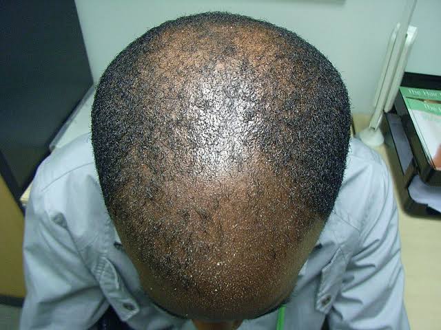 Nig_Farmer's tweet photo. #NaijaFarmerTips 

Do you want your Hair to grow?
Prevent hair breaking?
Stop Dandruff?

Onion Peels you throw away everyday is your ANSWER!

Boil your ONIONS PEELS..sieve out the water.. keep in a bootle &amp; apply to your hair.

Prevent Dandruff, hair loss, gives longer hair. https://t.co/5cKDqJp5Cf