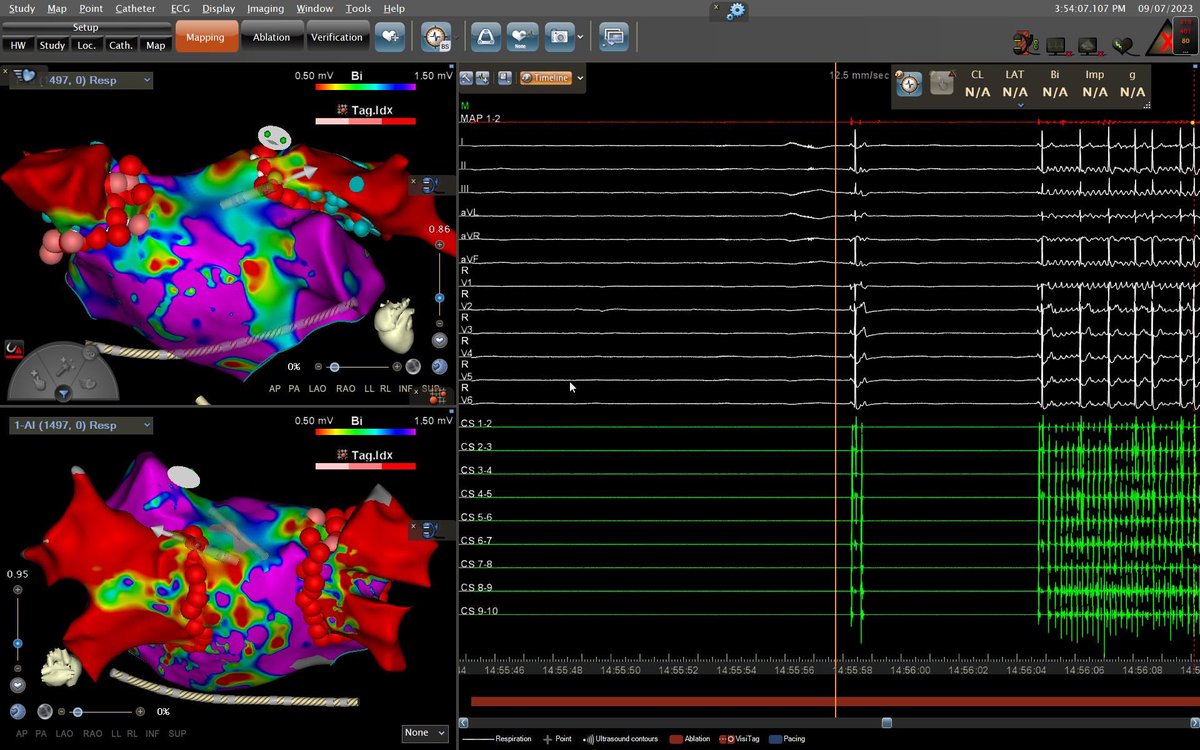 ๐ป๐๐๐๐ ๐ถ ๐ผ๐๐๐๐๐๐ (@laila_g) on Twitter photo #ePeeps We had a very nice case we wanted to share. 60s y/o woman with AF. Programed for PVI, during ablation in LSGP presented large sinus pause and AF spontaneous induction. #CardioTwitter #Cardiology <a href="/cardiologiaCHUS/">CARDIOCHUS</a> #ePeeps We had a very nice case we wanted to share. 60s y/o woman with AF. Programed for PVI, during ablation in LSGP presented large sinus pause and AF spontaneous induction. #CardioTwitter #Cardiology <a href="/cardiologiaCHUS/">CARDIOCHUS</a>