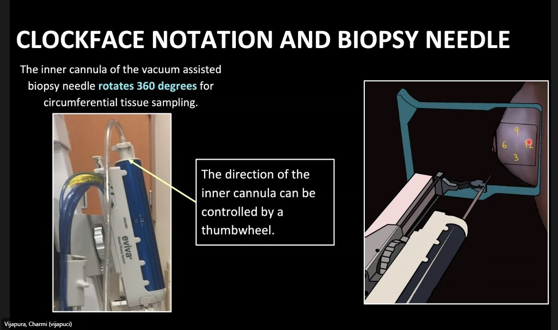 Excellent lecture yesterday on everything you need to know about performing a #stereotactic breast biopsy by our very own board member @CharmiMD ! Thank you for teaching our fellows! Key slides with great tips below!