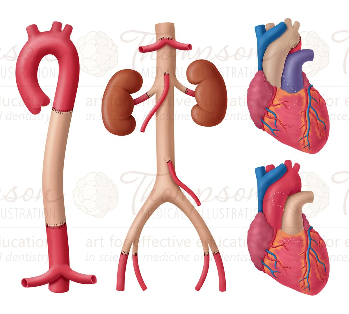 Medillustrates's tweet image. Part of a series by Molly Thompson, illustrating the size and location of various vascular grafts.

Explore more work by Molly Thompson: buff.ly/3gZLJ4e 

#vascularsurgery #cardiology #grafts #medical #illustration #medicalillustration #scientificillustration #3D #sciart