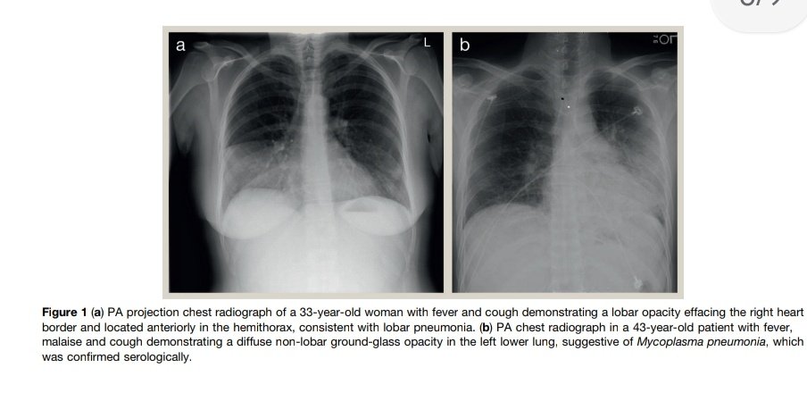 SOMELaguna's tweet photo. Radiología Torácica 🩺🫁

https://t.co/id0tQ2kwJ6

Enlace a Artículo Completo 👇🏼🆓️✅
https://t.co/RI53cNdEFq https://t.co/f98lnDCjnt