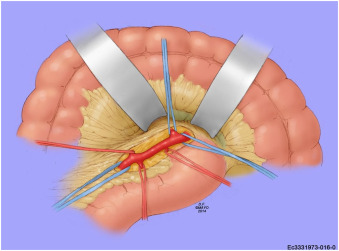 SeminarVascSurg's tweet image. "Acute management of mesenteric emergencies: Tailoring the solution to the problem"

Great overview of options for dealing with #AMI in this article by the @MayoVascSurgery group. Do you use #ROMS or an entirely open approach in your algorithm?

@MarioDOria14 @CaitlinWHicks