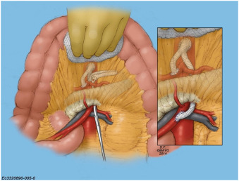 SeminarVascSurg's tweet image. "Acute management of mesenteric emergencies: Tailoring the solution to the problem"

Great overview of options for dealing with #AMI in this article by the @MayoVascSurgery group. Do you use #ROMS or an entirely open approach in your algorithm?

@MarioDOria14 @CaitlinWHicks