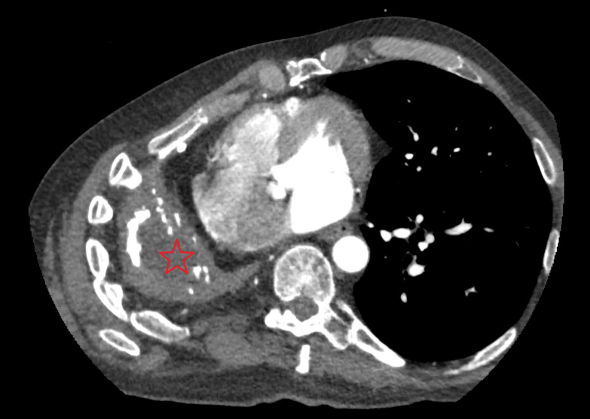 SharafGhaith's tweet photo. Exciting case to see again by
@AnwarChahal
AF ablation in patinet with a single lung!!
Great seeing micro reentrant tachycardia terminated on abltaion, see final lesions for results!
And all was done with ZERO fluroscopy!!!
@EOG_MD
#epeeps https://t.co/pMoMXyCi6b