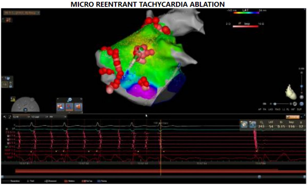 SharafGhaith's tweet photo. Exciting case to see again by
@AnwarChahal
AF ablation in patinet with a single lung!!
Great seeing micro reentrant tachycardia terminated on abltaion, see final lesions for results!
And all was done with ZERO fluroscopy!!!
@EOG_MD
#epeeps https://t.co/pMoMXyCi6b