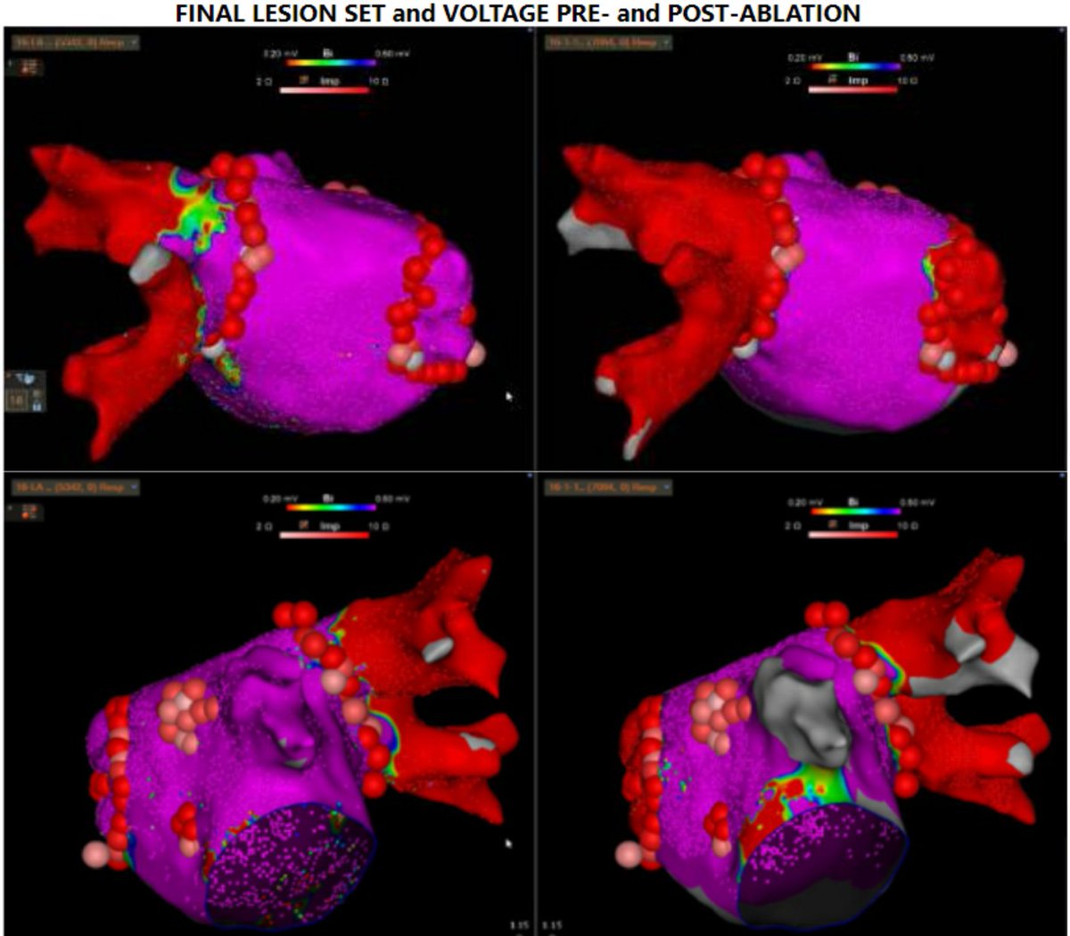 SharafGhaith's tweet photo. Exciting case to see again by
@AnwarChahal
AF ablation in patinet with a single lung!!
Great seeing micro reentrant tachycardia terminated on abltaion, see final lesions for results!
And all was done with ZERO fluroscopy!!!
@EOG_MD
#epeeps https://t.co/pMoMXyCi6b
