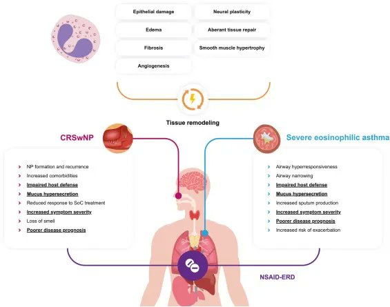 Aller_MD's tweet image. The #Unified #Airway #Hypothesis: Evidence From Specific Intervention With #Anti – #IL-5 #Biologic #Therapy. Open Access buff.ly/3r2Oz14