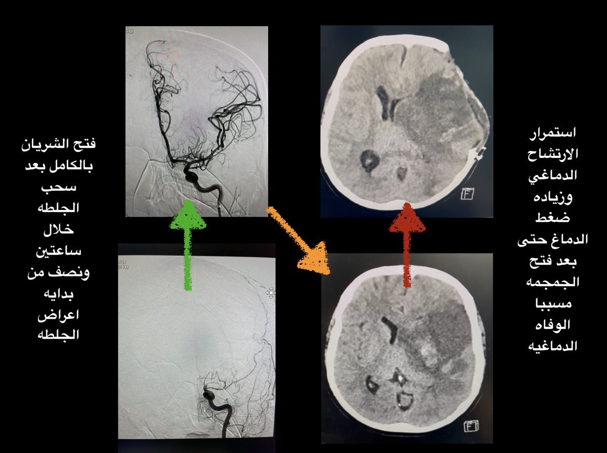 عند مناقشه سحب الجلطات الدماغيه الحاده، يجب معرفه اننا نطبق قاعده توقُّعيه مفادها ان ٣٠٪ من المرضى يرجع لطبيعته و٣٠٪ ينجو باعتلالات متفاوته تحتاج علاج تأهيلي و ٣٠٪ لا يتحسنوا و ١٠٪ قد يتدهورا بسبب نزيف تحوري في الجلطه او ارتشاح سوائل داخل الدماغ يزيد من ضغطه مسببا خطرا على الحياه