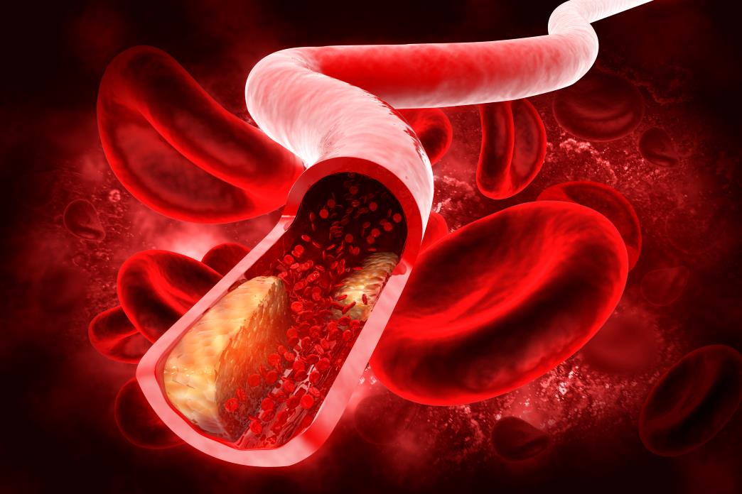Neurology Today (@neurologytoday) on Twitter photo Via <a href="/GreenJournal/">Neurology Journal</a>: A study has shed light on the safety of IVT for suspected ischemic stroke in patients with intracranial neoplasms, who typically are excluded from the procedure: bit.ly/3LcBHfz
#NeuroTwitter <a href="/AANMember/">American Academy of Neurology</a> <a href="/CroninNeuro/">Carolyn Cronin</a> <a href="/almuftifawaz/">Fawaz Al-Mufti, MD, FSVIN</a> <a href="/kaustubhslimaye/">Kaustubh Limaye</a> Via <a href="/GreenJournal/">Neurology Journal</a>: A study has shed light on the safety of IVT for suspected ischemic stroke in patients with intracranial neoplasms, who typically are excluded from the procedure: bit.ly/3LcBHfz
#NeuroTwitter <a href="/AANMember/">American Academy of Neurology</a> <a href="/CroninNeuro/">Carolyn Cronin</a> <a href="/almuftifawaz/">Fawaz Al-Mufti, MD, FSVIN</a> <a href="/kaustubhslimaye/">Kaustubh Limaye</a>