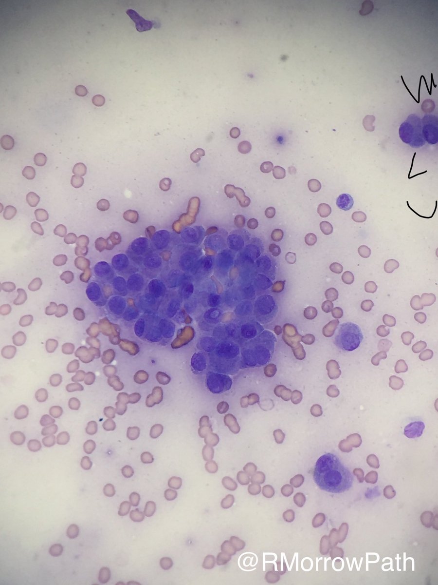 FNA suspicious thyroid nodule, middle aged lady. Background MNG. Bethesda category? Diagnosis? #fnafriday #pathology