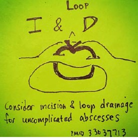 EMNews's tweet photo. #EPs should consider using the #incision &amp; #loopdrainage technique instead of conventional I&amp;D for uncomplicated #subcutaneous #abscesses, says @M_Lin 

Benefits include a smaller scar &amp; no packing changes. #FOAMed https://t.co/hx7rnwEIKN https://t.co/SoNAb1BelP