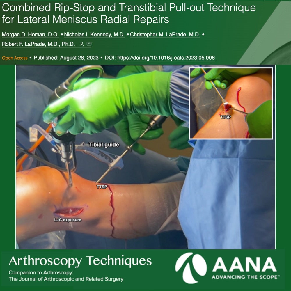 Combined Rip-Stop and Transtibial Pull-out Technique for Lateral Meniscus Radial Repairs <a href="/thekneedoc/">Robert LaPrade, MD</a> 

ow.ly/v6QN50PH4kV