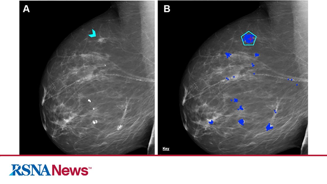 Using a standardized assessment, researchers in the UK compared the performance of a commercially available AI algorithm with human readers of screening mammograms. Results of their findings were published in <a href="/Radiology_rsna/">Radiology</a>. bit.ly/3PpBisW