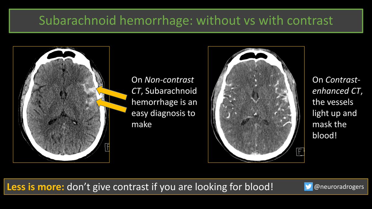 As a medical student, this concept was somehow difficult to believe. Seeing is believing, and I think this case speaks for itself! Don't give contrast for brain bleeds; less is more! The contrast often hides the blood.  #NeuroRad #MedTwitter #medicalstudent #radres #CriticalCare