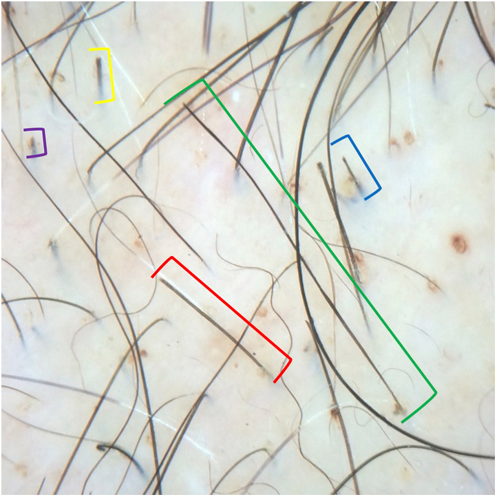#Trichoscopy is a noninvasive technique that provides valuable information for diagnosing and managing hair disorders. This JAAD article includes updated knowledge on the main trichoscopic features of common scarring and non-scarring alopecias. bit.ly/45MDxMz