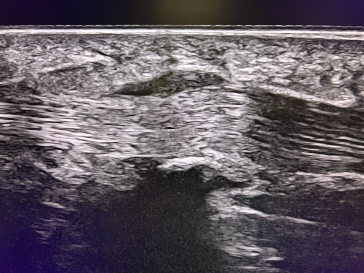 Trigger finger 
A1 pulley thickening of flexor tendon of thumb
24 MHz probe 

#mskrad #radres #mskultrasound