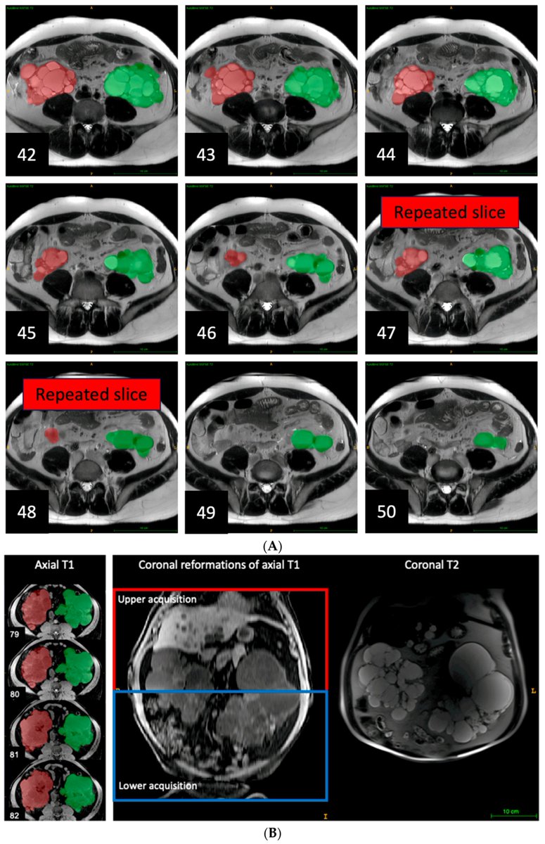 Tomography MDPI (@tomography_mdpi) on Twitter photo 💃Newly published hot paper:
Clinical Quality Control of #MRI Total #Kidney Volume Measurements in #Autosomal Dominant #Polycystic #Kidney Disease by Dr. Zhu, et al.
<a href="/Cornell/">Cornell University</a> <a href="/WCMRadiology/">Weill Cornell Medicine Radiology</a> <a href="/sharbatdara1/">Arman Sharbatdaran</a> <a href="/WeillCornell/">Weill Cornell Medicine</a> <a href="/ColumbiaPS/">Columbia Vagelos College of Physicians & Surgeons</a>
mdpi.com/2379-139X/9/4/… 💃Newly published hot paper:
Clinical Quality Control of #MRI Total #Kidney Volume Measurements in #Autosomal Dominant #Polycystic #Kidney Disease by Dr. Zhu, et al.
<a href="/Cornell/">Cornell University</a> <a href="/WCMRadiology/">Weill Cornell Medicine Radiology</a> <a href="/sharbatdara1/">Arman Sharbatdaran</a> <a href="/WeillCornell/">Weill Cornell Medicine</a> <a href="/ColumbiaPS/">Columbia Vagelos College of Physicians & Surgeons</a>
mdpi.com/2379-139X/9/4/…