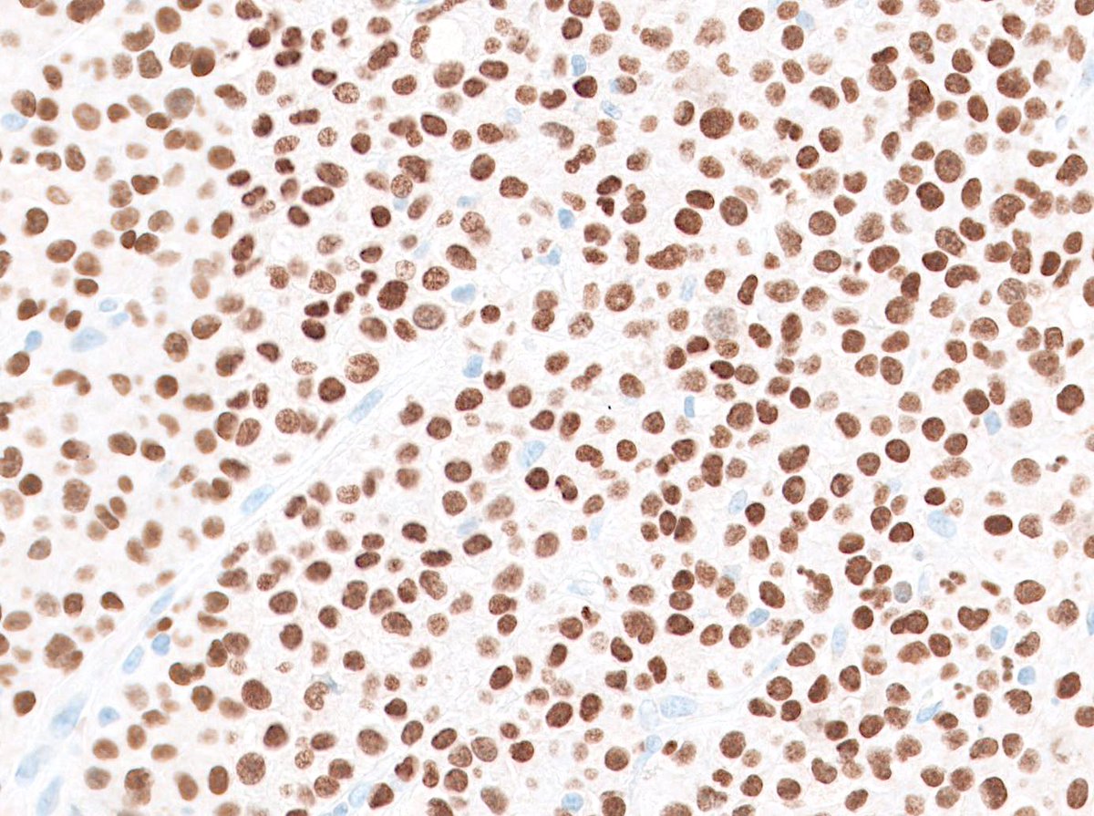 Histiocytic sarcoma presenting as a soft tissue mass - when it comes to this diagnosis, PU doesn't stink. #BSTpath #IHCpath