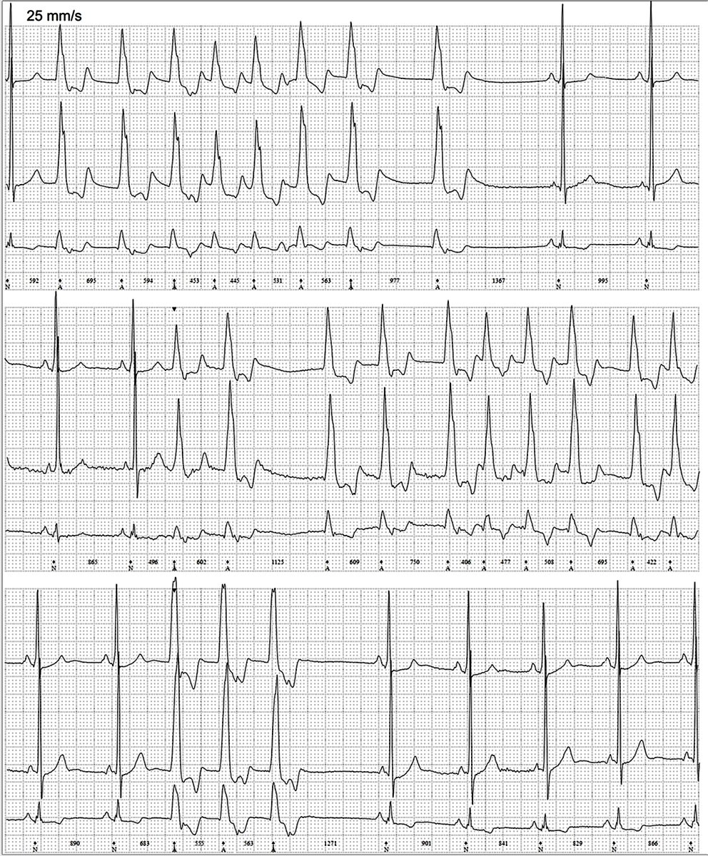 ecgandrhythmRoe's tweet photo. 58 yo male, DCM, palpitations; 3 Holter strips; rhythm?
@ecgrhythms @ECGEPSCADEVICE https://t.co/Pu4fmxZr25