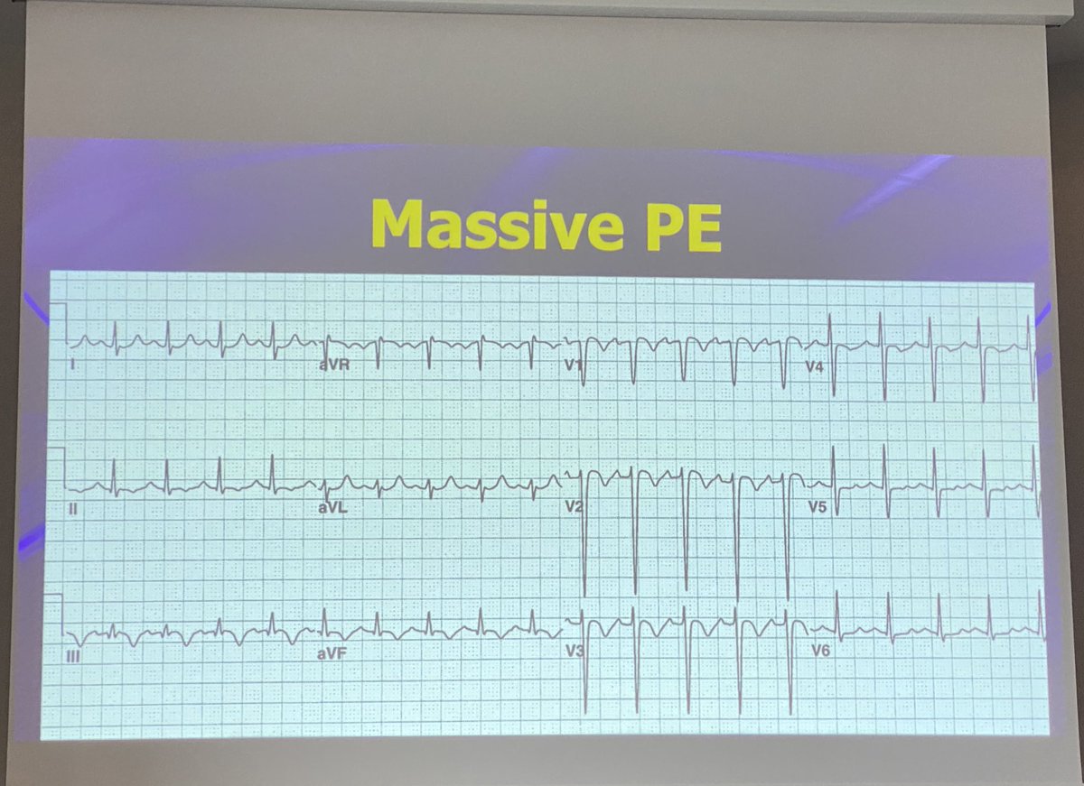 Matt Sztajnkrycer (@noobiematt) on Twitter photo <a href="/amalmattu/">Amal Mattu</a> at #MEMC23
Simultaneous T wave inversions in inferior AND anteroseptal leads is predictive of PE.
Studies suggest 75 - 99% predictive. <a href="/amalmattu/">Amal Mattu</a> at #MEMC23
Simultaneous T wave inversions in inferior AND anteroseptal leads is predictive of PE.
Studies suggest 75 - 99% predictive.