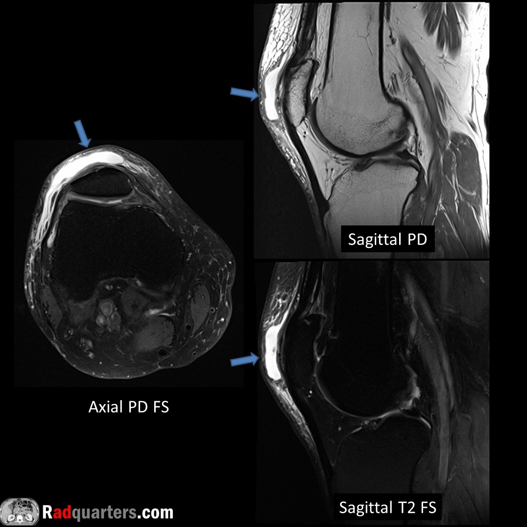 Prepatellar bursitis. Fluid accumulation anterior to patella in prepatellar bursa (arrows). Typically caused by direct trauma or repetitive kneeling. Less commonly caused by gout, RA, or infection. May see calcifications if chronic. #FOAMrad #mskrad #radres #medstudent