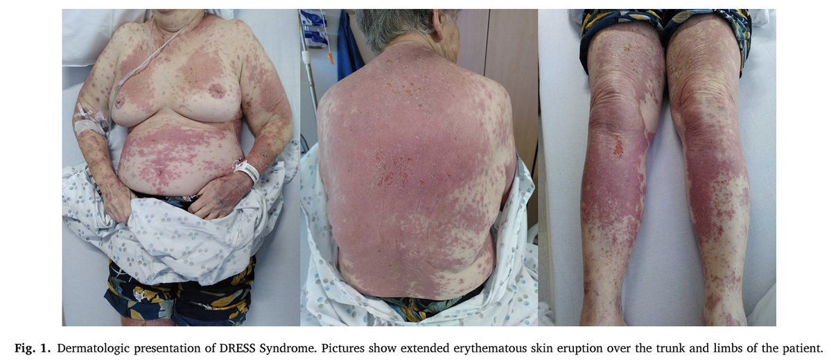 European Journal of Internal Medicine (@ejim_journal) on Twitter photo ▶️INTERNAL MEDICINE FLASHCARD◀️
Bad luck comes in threes
👇👇👇👇🖇️
ejinme.com/article/S0953-…
<a href="/JacopoImberti/">Jacopo Imberti</a> <a href="/monicasolbiati/">monica solbiati</a> ▶️INTERNAL MEDICINE FLASHCARD◀️
Bad luck comes in threes
👇👇👇👇🖇️
ejinme.com/article/S0953-…
<a href="/JacopoImberti/">Jacopo Imberti</a> <a href="/monicasolbiati/">monica solbiati</a>