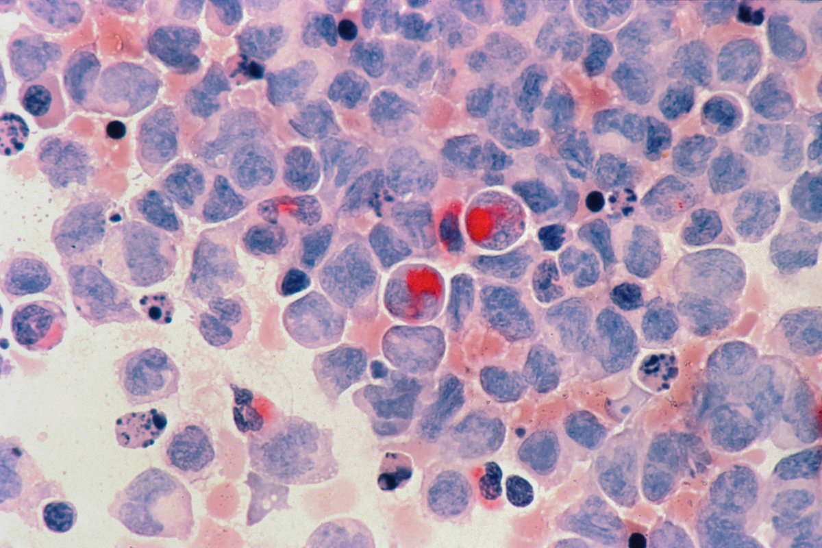 beauantoine's tweet photo. Mercredi, une dépêche a annoncé une hausse de 80% des cancers chez - de 50 ans. 

Quasiment tous les médias ont repris tel quel, qualifiant la progression d'"inquiétante" ou de "spectaculaire"…

Y a-t-il une épidémie de cancer chez les jeunes ?
Spoiler : NON. https://t.co/TT4JZn1DxK