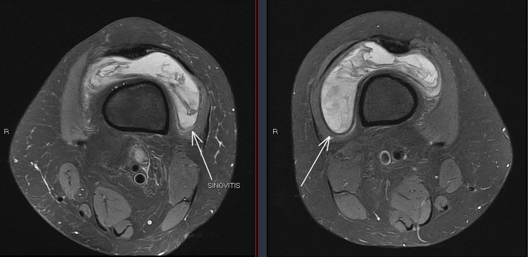 themskarchive's tweet photo. 8/9/2023. Bilateral effusion + synovitis + femorotibial chondropathy + periarticular ostepenia in middle-aged woman = high likelihood of rheumatoid arthritis. In treatment with Metrotexate. 🦵💡 #Rheumatology #synovitis #knee #inflamatoryactivity #MSK https://t.co/JffrQ6qNQS