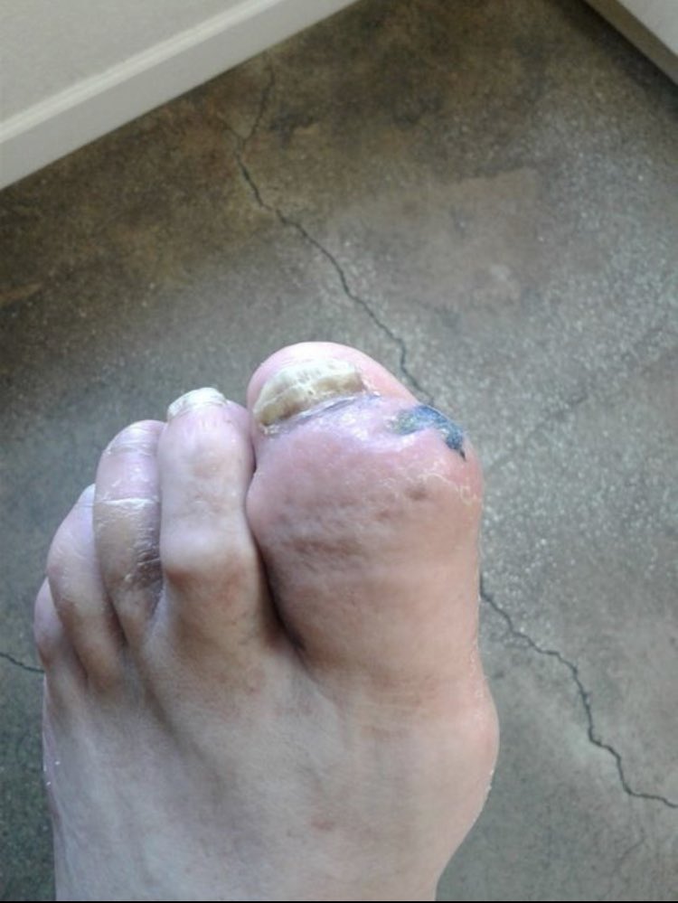 myAAWC's tweet photo. Let's start off our #ShowYourToes Month with a quiz. What condition do you think is causing the changes noted on this patient's toes? Comment with your responses and remember to share your own images with our hashtag.

A) Diabetes
B) Gout
C) Cancer
D) Trauma https://t.co/nhZPU4Zy1R