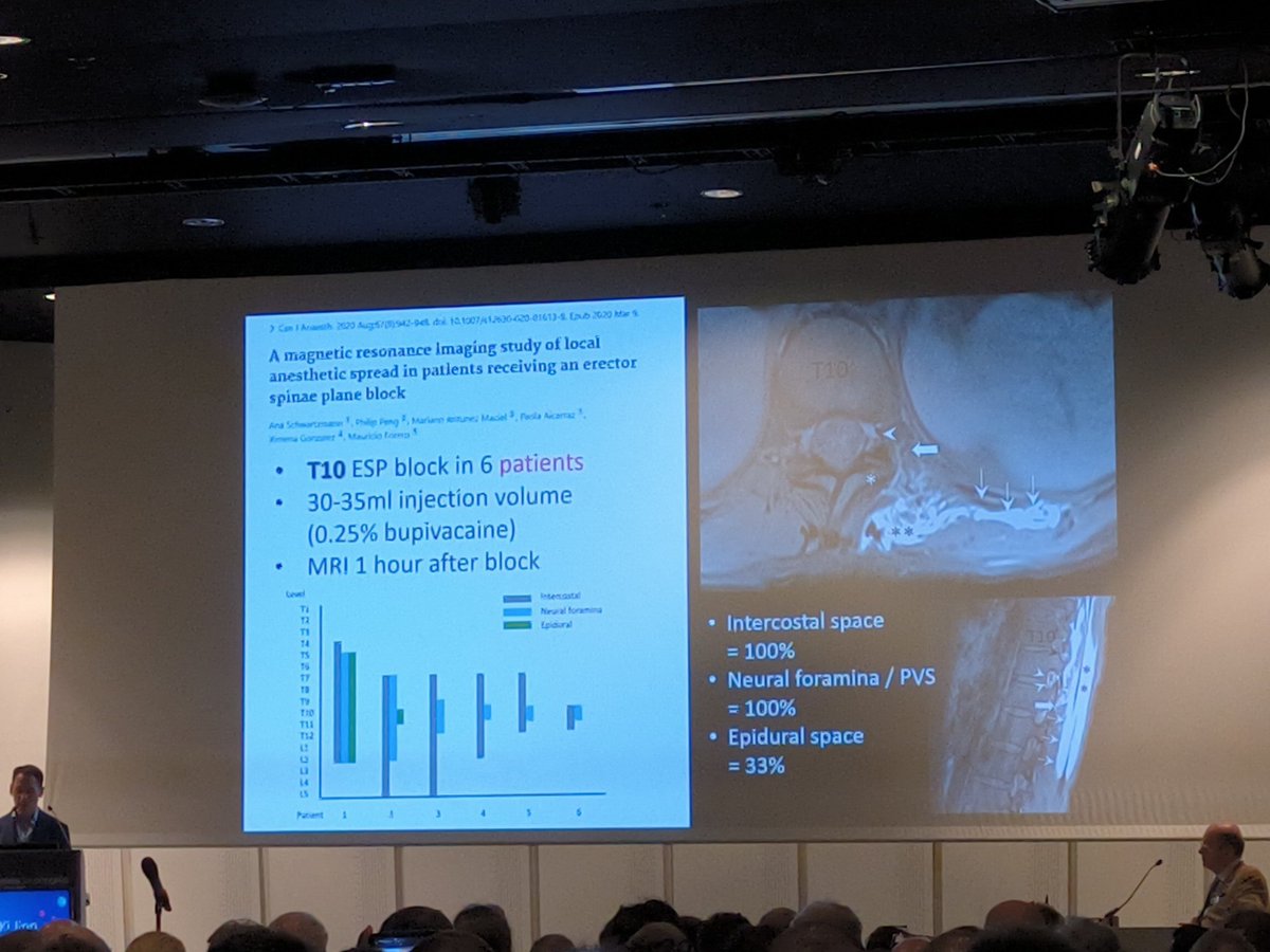 tsmurali's tweet photo. Pro-con debate at #ESRAworld2023
@KiJinnChin #ESPB Vs Dr Manoj Karmakar #PVB
๐ฅLA spreads to deeper planes - #DRG
โ๏ธ cutaneous sensory loss โ with meaningful Analgesia
โก fractional dose of LA - differential blockade
โญ #ESPB is good enough - in amateur hands too @IJA_web https://t.co/s9A6r4lj2u