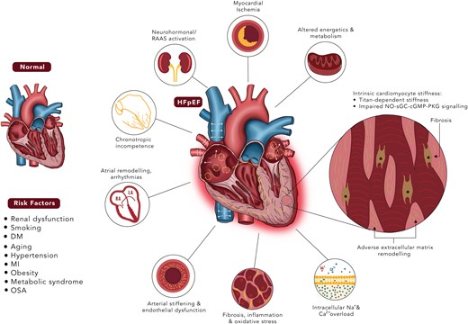 SeguraCardio's tweet photo. 📌Mechanisms of benefits of #SGLT2i in #HeartFailure with preserved ejection fraction

#cardiotwitter #cardioEd #Review #SGLT2 #HFpEF https://t.co/dt2qH0JF4e