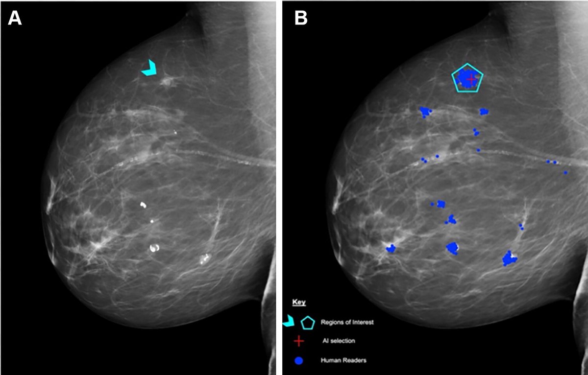 Normally used to assess the performance of human readers, the Personal Performance in Mammographic Screening (PERFORMS) scheme was used to evaluate the performance of an AI detection algorithm in this study by Chen et al. bit.ly/462nR7y
