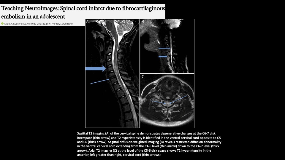 🧠Similar controversial case of acute spinal cord infarct in a young patient

All the workups for the underlying etiology were negative

In a young patient with no risk factors, rare possibility of fibrocartilaginous emboli can be considered. Though cannot be proved 

#neurorad