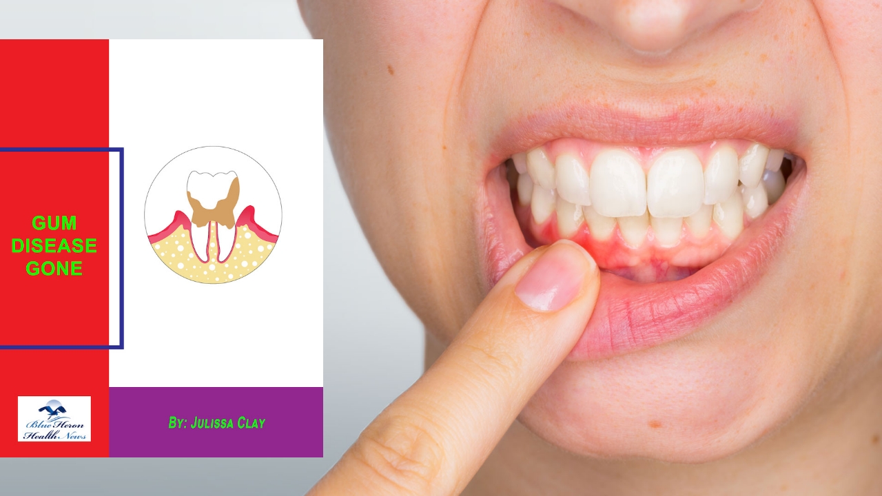 poneks on X: "Gum Disease Gone By Julissa Clay ✓ Website 👉  https://t.co/R6S0JMz5z3 Are you experiencing gum diseases? Do you want a  safe, natural, and effective solution? Many of us experience gum