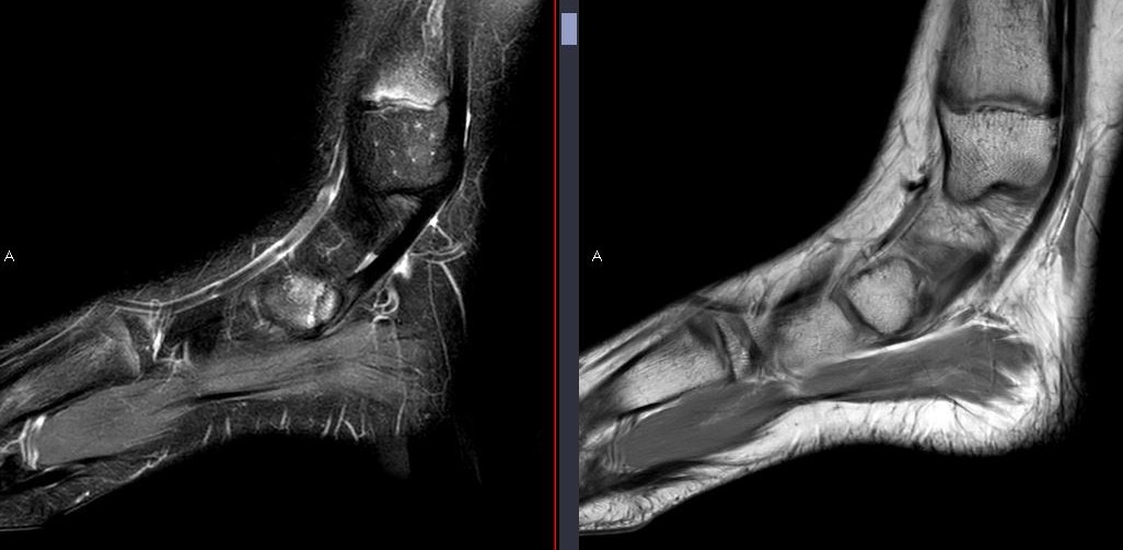 themskarchive's tweet photo. 8/9/2023. 13-year-old with medial midfoot pain. Signs of traction apophysitis of the scaphoid's medial ossification center, pulled by the posterior tibialis tendon, with bone marrow edema on both sides of the synchondrosis. 🦶🧒💡 #PediatricOrtho #MSKRadiology #Apophysitis https://t.co/H5bMT8C0yZ