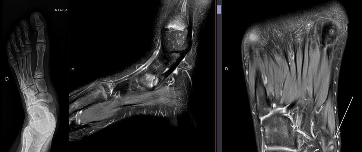 themskarchive's tweet photo. 8/9/2023. 13-year-old with medial midfoot pain. Signs of traction apophysitis of the scaphoid's medial ossification center, pulled by the posterior tibialis tendon, with bone marrow edema on both sides of the synchondrosis. 🦶🧒💡 #PediatricOrtho #MSKRadiology #Apophysitis https://t.co/H5bMT8C0yZ