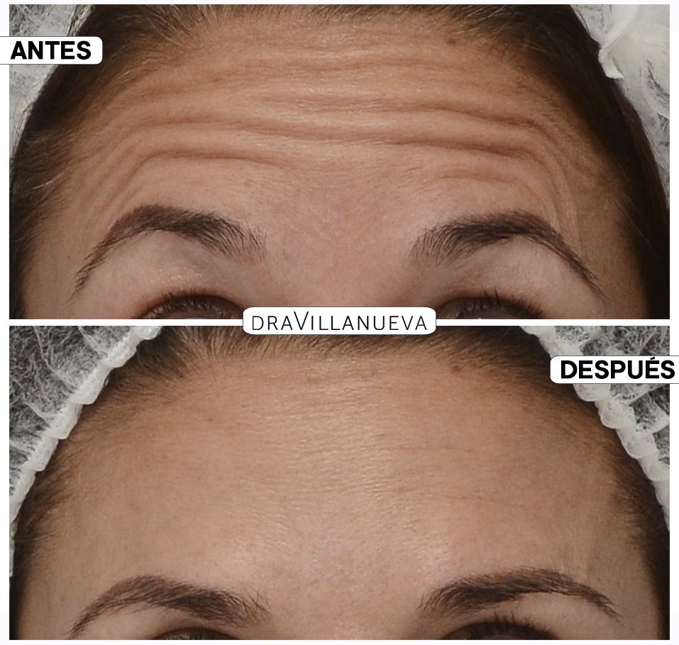 ¿Te preguntas cómo eliminar o disminuir las arrugas transversales para rejuvenecer tu rostro? Sin duda, mi respuesta a esta pregunta es el tratamiento con #neuromoduladores 😊.
*Más ℹ️ en mi web 👉 dravillanueva.com/medicina-estet…
📸 “Antes y después” de una de mis pacientes. 
#Barcelona
