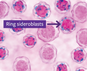 poombal_'s tweet image. Ring sideroblasts, a rare blood disorder! Iron accumulates abnormally in red cell precursors&apos; mitochondria, creating rings around the nucleus. 🧪💉 #RingSideroblasts #PathTweeter #PathX
