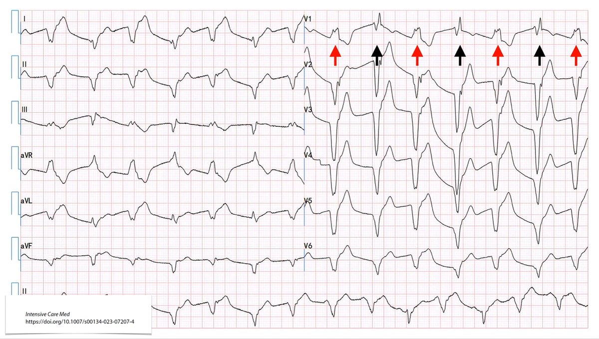 yourICM's tweet image. What could you see here &amp;amp; what is going on?
💊 59y male, metastatic cancer, started on immune checkpoint inhibitor. After the first cycle
🫀 chest discomfort
🖥️ 49% EF + ant LV wall dysfunction
🧪 elevated troponin I + BNP
⚡️ ECG was performed…
#FOAMcc
🔓 rdcu.be/dlESy