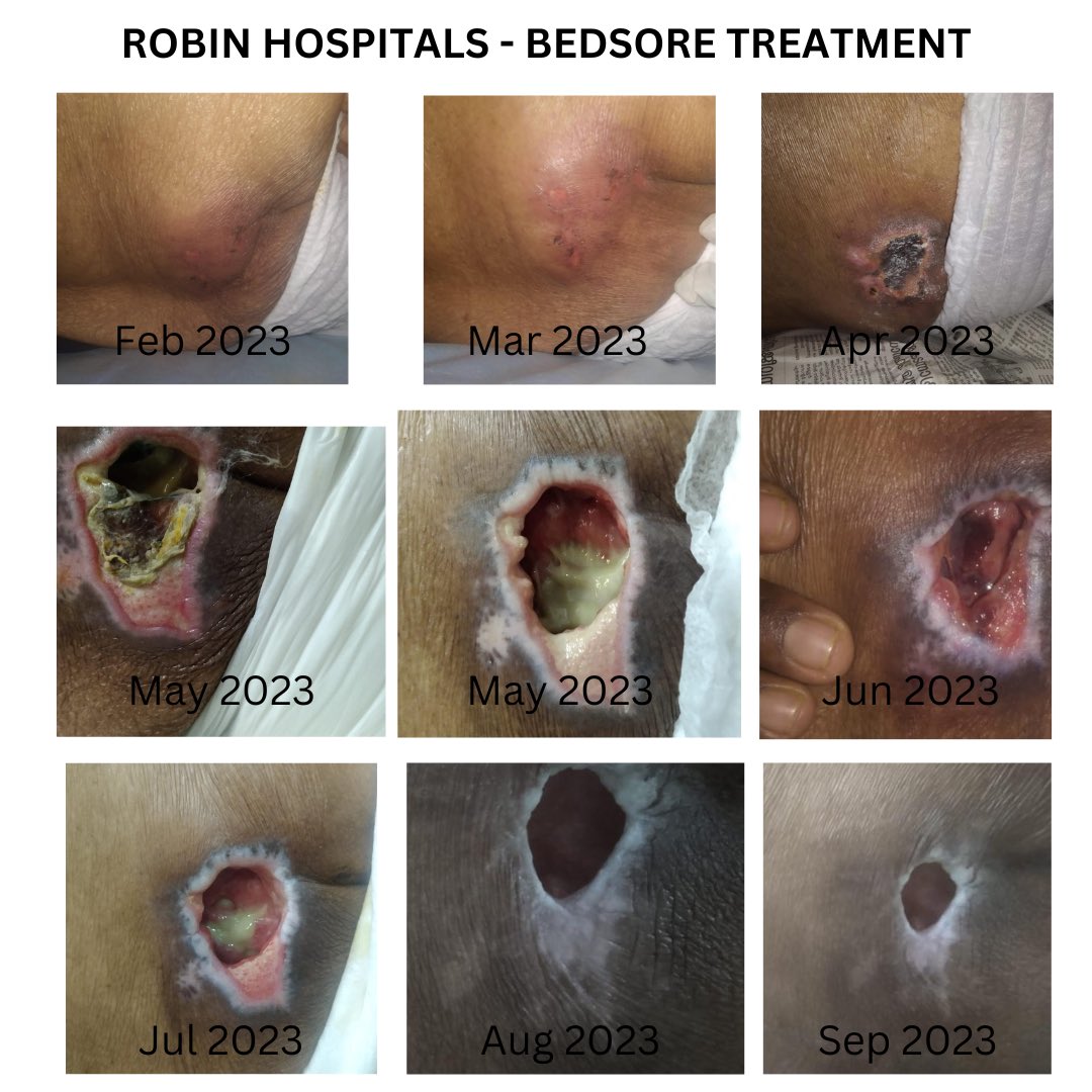 See how we treated our patients bed sore. Thanks to our homecare nurses. 

#bedsore #decubitusulcer #homecare #Wound #woundtreatment