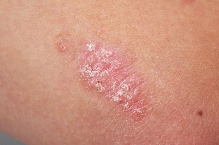 hormonedietdoc's tweet photo. Psoriasis: What I never see. Topical creams, corticosteroids & immunosuppressant drugs ever doing more than symptomatic relief at the expense of longer-term damage 

What I do see. Problematic foods eliminated, Intestinal restoration to stop the permeability in the gut wall junctions, nutritional liver support, Vitamins A,D &K, a #LCHPMF diet & sunshine = clear the skin at the root cause.
#psoriasis #skin #autoimmune #functionalmedicine