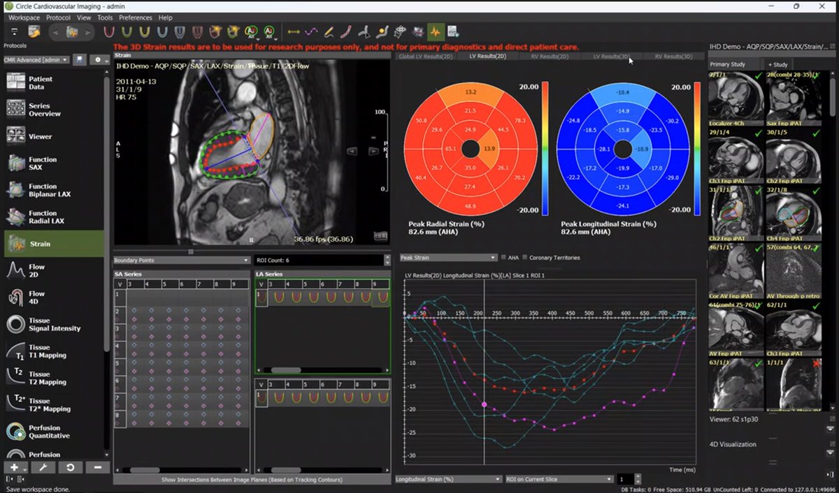 👩‍💻 👩‍💻 Today at Scan With Me (SWiM)... …Anne Hui Sze Kwong, Clinical apps lead @circlecvi gave an enlightening session on image processing for CMR with cvi42. Discover circle's intuitive features, like AI-based contour detection and 4D Visualization. #SWiM #CMRtraining🌟