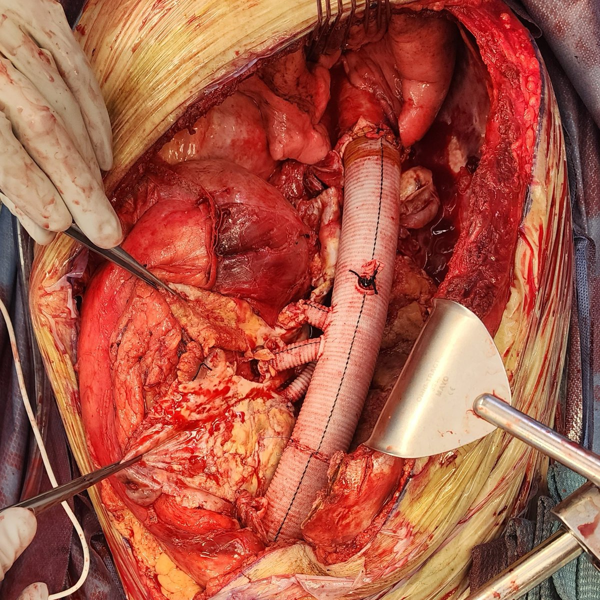 CAMCVascularIAM's tweet photo. A few weeks ago, we got to perform an open type III thoracoabdominal aneurysm repair with partial EVAR explanation. https://t.co/FuMPKsEvHJ
