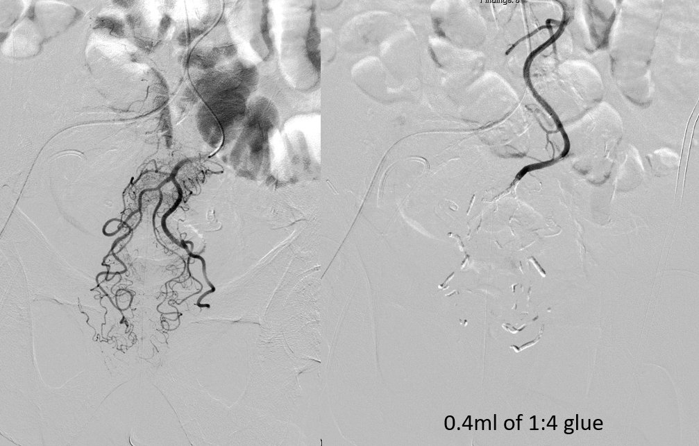 MohmdHalaibeh's tweet photo. 65 YOM s/p hemorrhoidectomy came in a week later with bleeding hemoglobin of 5, received 6 units for ongoing rectal bleeding.
Embolized with glue. Two months follow up reported no bleeding!
#TWITTIR #medtwitter #twittermd #irad #MedTwitter
#truFill https://t.co/lkaTn1Pe2M