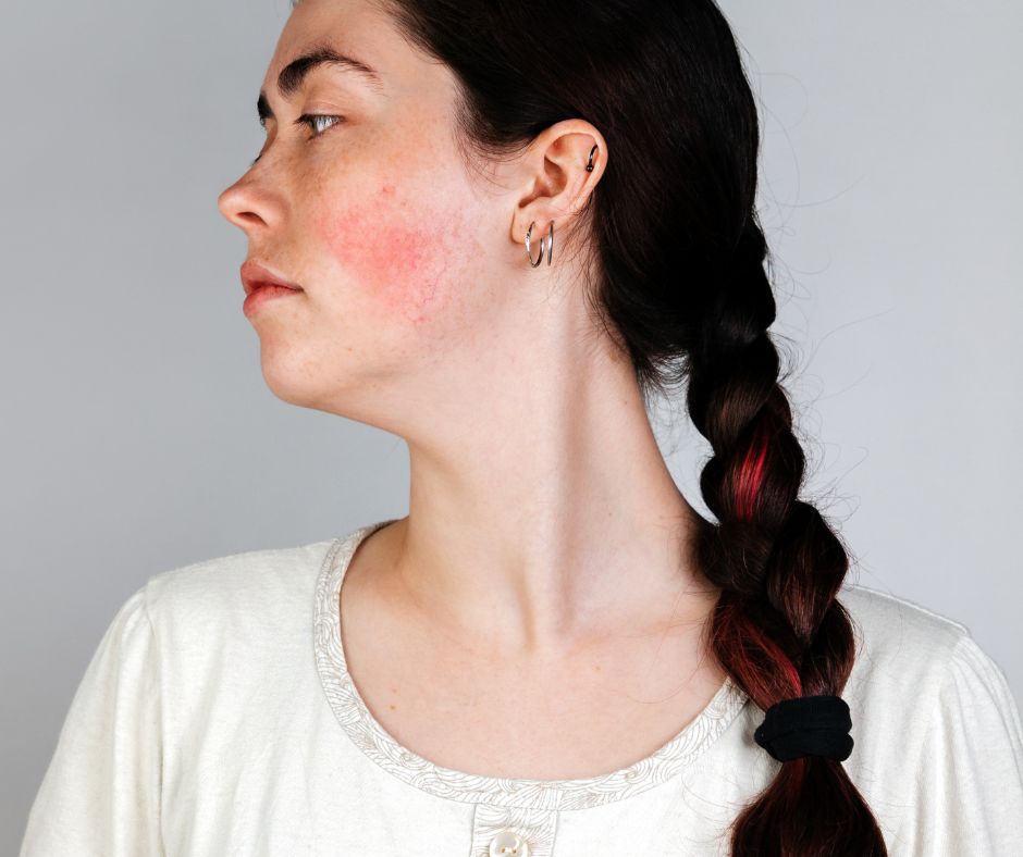 Understanding Rosacea: A Compassionate Guide to Living with the Condition madebycoopers.com/blogs/news/und…