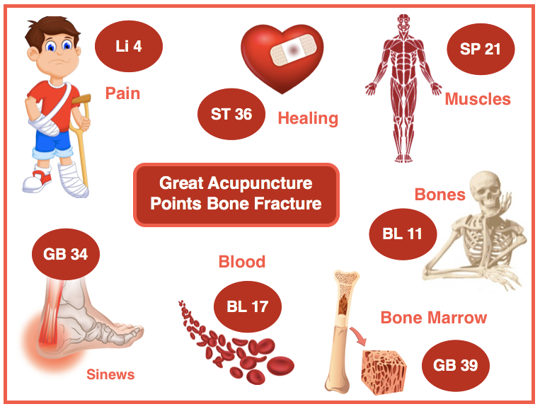 AcuProAcademy's tweet photo. 🩻When it comes to bone fractures, there are many #acupuncture points (local and distal) that can be used as part of a treatment protocol, but these are always a must for a faster healing process. 

#TCM on Bone Fractures: when a fracture occurs the whole body is affected. https://t.co/7DgznZMMZK