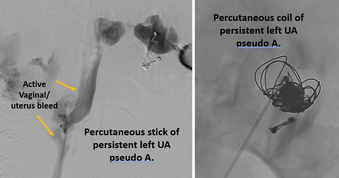 ArizonaVIR's tweet photo. G1P1 desires fertility preservation s/p extended left c-section c/b unstable vaginal bleed.  Angio: large UA psA bleed. UA small/tortuous initially s/p endo prox coil; however, persistent bleed s/p definitive perc. stick &amp; coil
@HannallahMD @woodhead @shamaryoungmd @goldmembermd https://t.co/hzj3ohxuzW